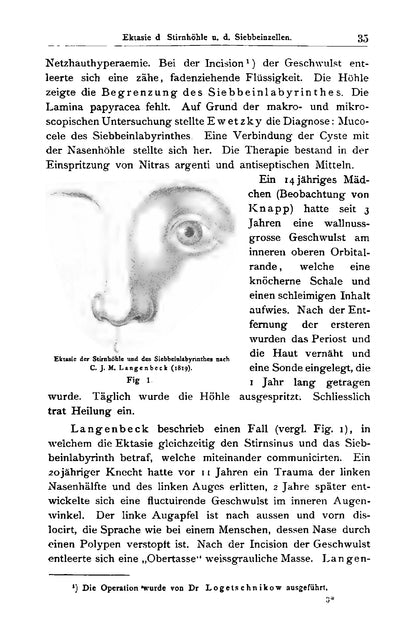 Die Krankheiten der Keilbein-Höhle und des Siebbein-Labyrinthes - Page 45